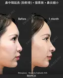 肋軟骨鼻フル after画像 サムネイル用