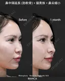 肋軟骨鼻フル after画像 サムネイル用