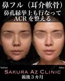 オーダーメイド鼻フル before画像 サムネイル用