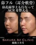 オーダーメイド鼻フル after画像 サムネイル用