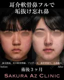 オーダーメイド鼻フル before画像 サムネイル用