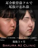 オーダーメイド鼻フル 90日後 サムネイル用