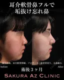 オーダーメイド鼻フル 90日後 サムネイル用