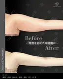 二の腕脂肪吸引（二の腕振袖・肩） after画像 サムネイル用