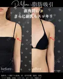 二の腕脂肪吸引（二の腕フル：二の腕振袖・肩・肩骨横・ブラファット） after画像 サムネイル用