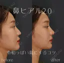 鼻ヒアルロン酸 after画像 サムネイル用