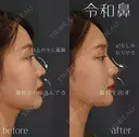鼻ヒアルロン酸 after画像 サムネイル用