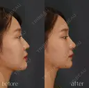鼻ヒアルロン酸 after画像 サムネイル用
