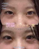 涙袋ヒアルロン酸 after画像 サムネイル用