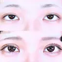 アリエルクイックループダブル二重埋没法/涙袋ヒアルロン酸 90日後 サムネイル用