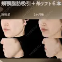 顔脂肪吸引＋糸リフト before画像 サムネイル用