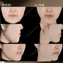 顔脂肪吸引＋糸リフト after画像 サムネイル用