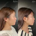 小顔整形－複合－ after画像 サムネイル用