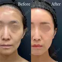 全顔脂肪注入(額・こめかみ・頬骨下・目の下〜ゴルゴ・ほうれい線)  after画像 サムネイル用