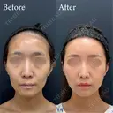 全顔脂肪注入(額・こめかみ・頬骨下・目の下〜ゴルゴ・ほうれい線)  after画像 サムネイル用