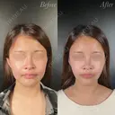 小顔整形－複合－ before画像 サムネイル用