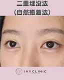二重埋没(自然癒着) after画像 サムネイル用