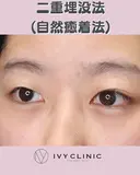 二重埋没(自然癒着) before画像 サムネイル用