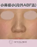 小鼻縮小(内外ABF法) before画像 サムネイル用