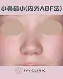 小鼻縮小(内外ABF法) after画像 サムネイル用