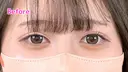涙袋ヒアルロン酸　ボルベラ before画像 サムネイル用