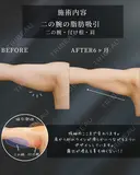 もう隠さない二の腕に🪄 before画像 サムネイル用