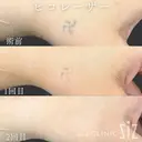 【タトゥー除去】自分で入れた卍 before画像 サムネイル用
