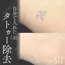 【タトゥー除去】自分で入れた卍 after画像 サムネイル用