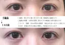 目頭切開法 before画像 サムネイル用