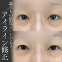 【アートメイク除去】26年もの肌色アートでも× after画像 サムネイル用
