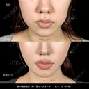 小顔脂肪吸引 after画像 サムネイル用
