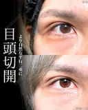 目頭切開 before画像 サムネイル用