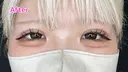 エターナル二重術 after画像 サムネイル用
