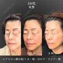 フェイスリフト/ヒアルロン酸注入 after画像 サムネイル用