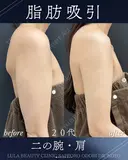 二の腕+肩　脂肪吸引 31日後 サムネイル用