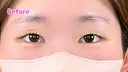 エターナル二重術 before画像 サムネイル用