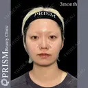 バッカルファット除去、鼻先リフト（クローズド法＋3D法）、小鼻縮小（内側切開法） 90日後 サムネイル用