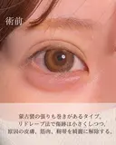目頭切開 before画像 サムネイル用