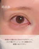 目頭切開 after画像 サムネイル用
