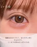 目頭切開 30日後 サムネイル用