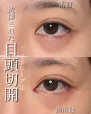 目頭切開リドレープ法 after画像 サムネイル用