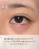 目頭切開リドレープ法 before画像 サムネイル用