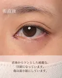 目頭切開リドレープ法 after画像 サムネイル用