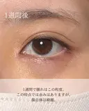 目頭切開リドレープ法 after画像 サムネイル用