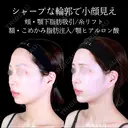 頬・顎下脂肪吸引/糸リフト/額・こめかみ脂肪注入/顎ヒアルロン酸 before画像 サムネイル用