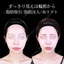 頬・顎下脂肪吸引/糸リフト/額・こめかみ脂肪注入/顎ヒアルロン酸 90日後 サムネイル用