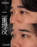 Dr岩切💙二重埋没💙 30日後 サムネイル用