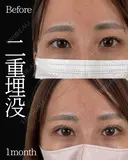 Dr岩切🎀二重埋没🎀 before画像 サムネイル用