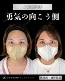 Dr浦野執刀🎀二重埋没法 before画像 サムネイル用