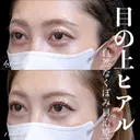 目の上ヒアルロン酸 before画像 サムネイル用